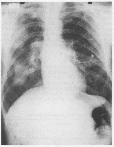 Progressive Massive Fibrosis With Egg Shell Calcification Of Hilar