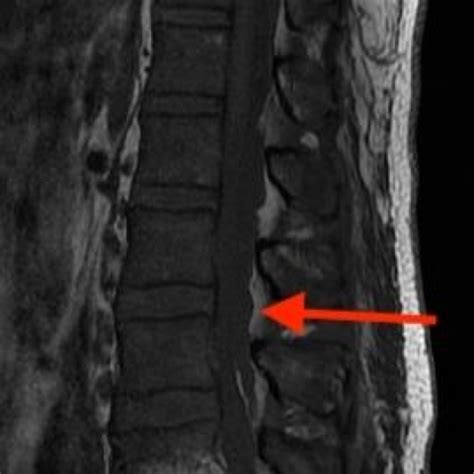 Epidural Abscess Mri Lumbar