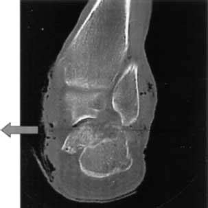 -CT-scan of an open calcaneal fracture with medial skin perforation ...