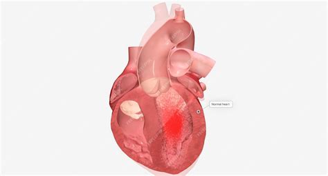 Premium Photo | Cardiomyopathy is a disease of the heart muscle that ...