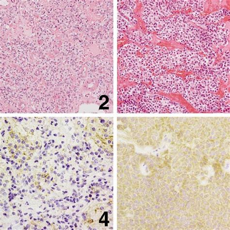 Photomicrograph Of The Surgical Specimen Of The Cerebellar Tumor