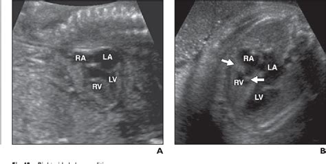 Figure 1 From Ultrasound Of Fetal Cardiac Anomalies Semantic Scholar