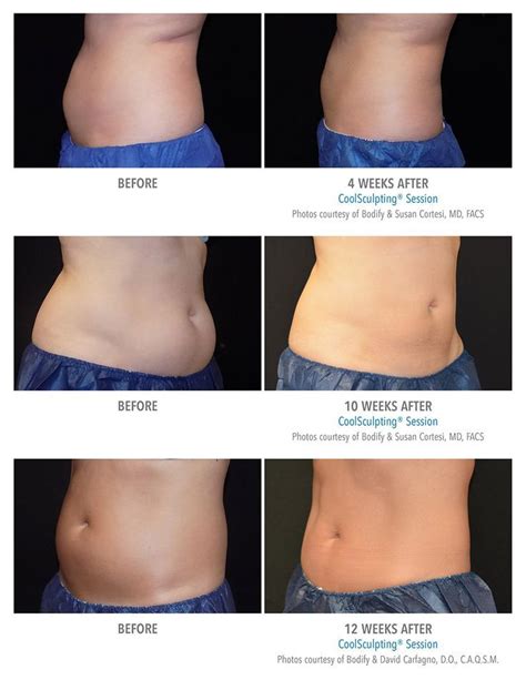 Coolsculpting Before And After Photos Results By Bodify Cool Sculpting Coolsculpting Before