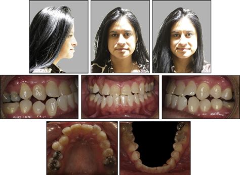 Figure From Camouflage Treatment Of Skeletal Class Iii Malocclusion