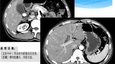 肝内胆管炎症的ct、mri影像表现腾讯视频