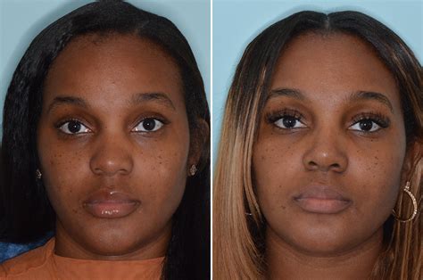 Ethnic Rhinoplasty Photos Dr Anthony Bared Md Facial Plastic Surgeon