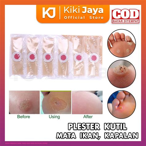 Jual KIKI Plester Untuk Kutil Mata Ikan Kaki Kapalan Obat Koyo