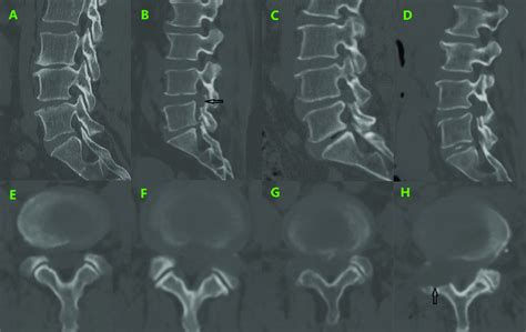 Postoperative Sagittal Reconstruction A D And Axial E H Ct Image Download Scientific