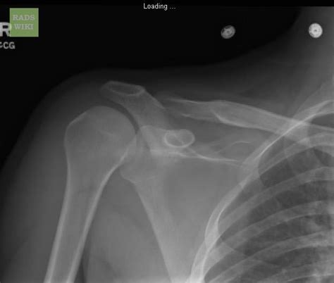 Shoulder dislocation x ray - wikidoc