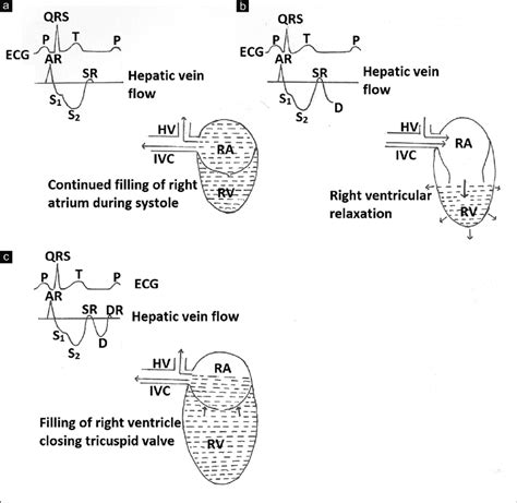 A Filling Of Right Atrium Produces Backflow In Hepatic Vein Producing