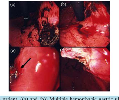 Table From A Case Of Multiple Hemorrhagic Gastric Ulcers Developed