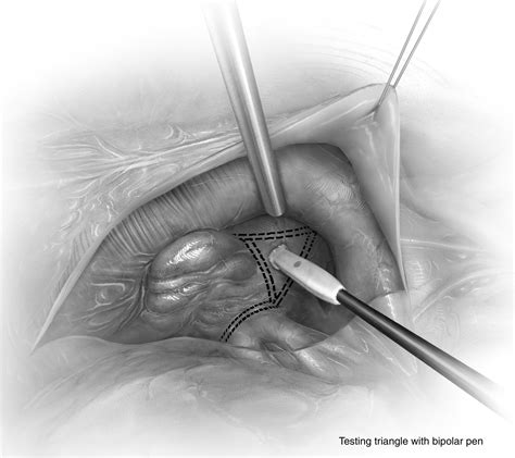 Total Thorascopic Ablation Of Atrial Fibrillation Using The Dallas