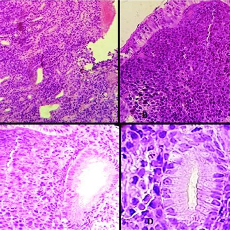 Typical Cutaneous Kaposis Sarcoma Lesion Download Scientific Diagram