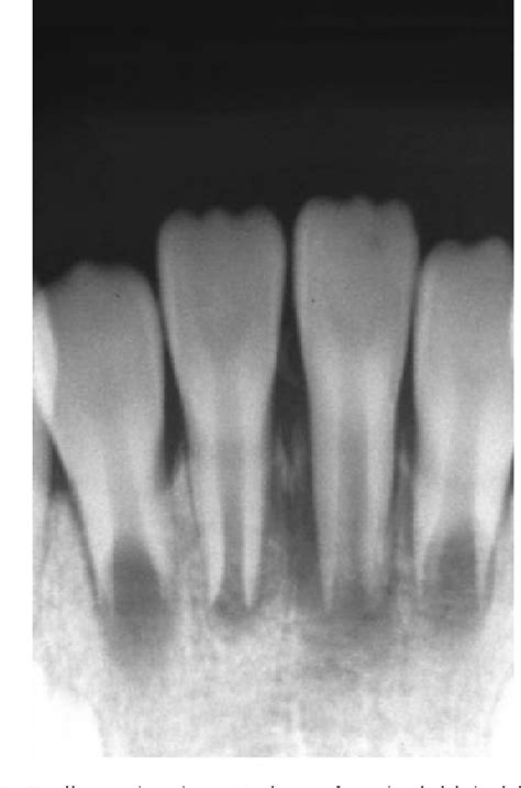 Revascularization Of An Immature Permanent Tooth With Periradicular