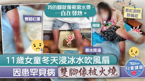 【罕見病】11歲女童患罕見病雙腳像被火燒 冬天浸冰水吹風扇舒緩不適 Accessible Articles Hong Kong One Stop ♿ Accessible