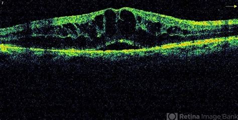 Cme Oct Retina Image Bank