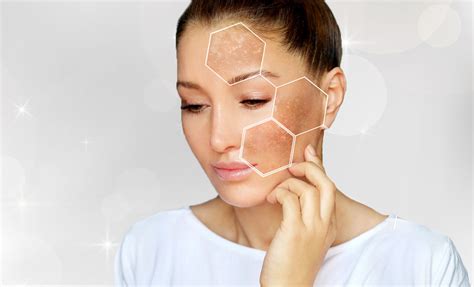 Melasma Sul Viso Trattamenti E Cure Dr Aurelio Portincasa