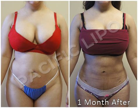 64 Best Liposuction Results Images On Pinterest