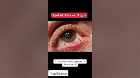 Is Your Eyelid Trying to Tell You Something? 5 Warning Signs of Eyelid ...