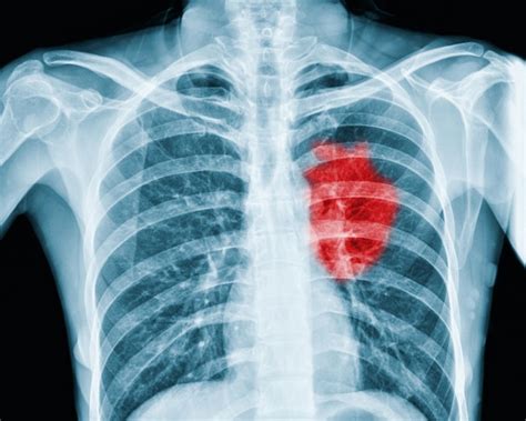 Raio X Coração Grande - Anatomia Do Coracao De Raio X Radiologia E Diagnóstico Por Imagem: