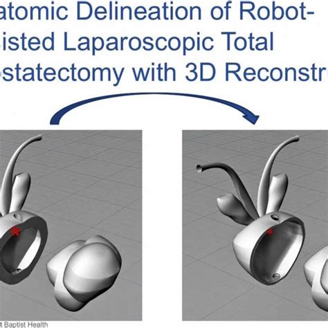 Anatomic Delineation Of Robot Assisted Laparoscopic Total Prostatectomy