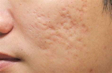 Acne Scar Removal In Singapore The Ogee Clinic