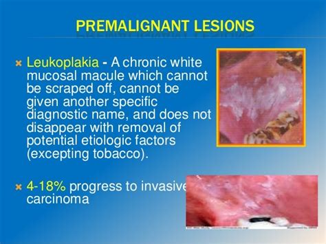 Carcinoma Buccal Mucosa