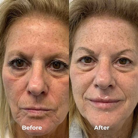 Rf Microneedling Before After Results