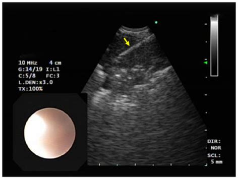 Full Article Endobronchial Ultrasound Guided Transbronchial Fine