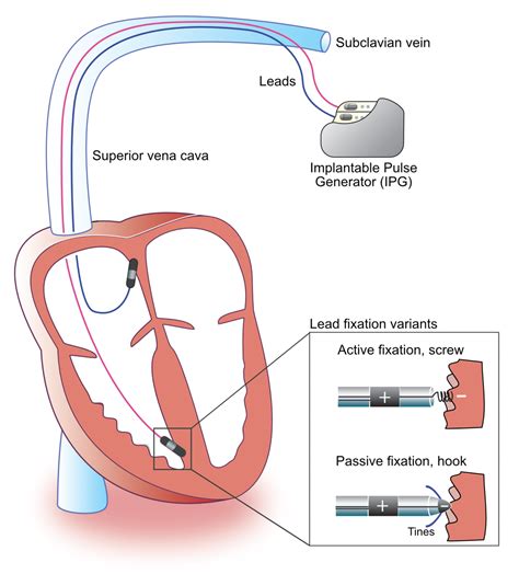 Components And Construction Of A Pacemaker The Cardiovascular