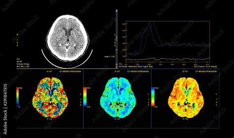 Obraz Ct Brain Perfusion Or Ct Scan Image Of The Brain D Rendering