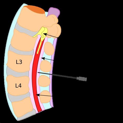 Epidural blood patch - Alchetron, The Free Social Encyclopedia