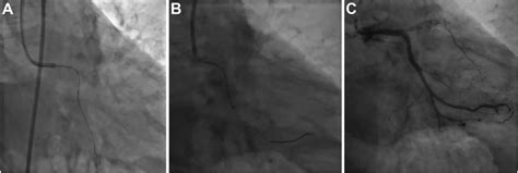 Deployment of the Left Main-Left Circumflex Stent | Download Scientific ...