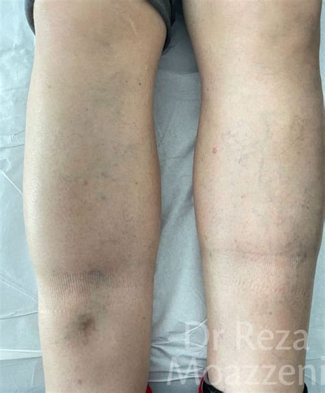 Unilateral Leg Swelling Chronic Venous Stasis Vs Lymphedema