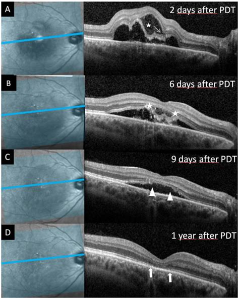 Bacillary Layer Detachment Associated With Photodynamic Therapy Related