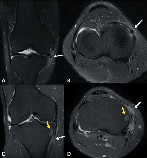 Scielo Brasil Imaging Findings Of Acute Calcific Periarthritis