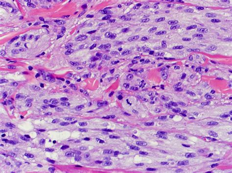 Granular Cell Tumor Larynx