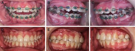 Case 2 Patient Has A Class Ii Malocclusion With An Anterior Open Bite Download Scientific