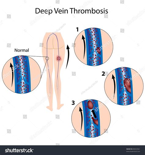 Deep Vein Thrombosis Stock Illustration 89653561 Shutterstock