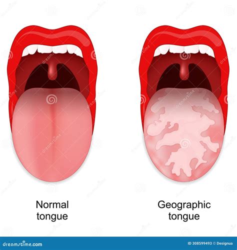 Geographic Tongue Benign Migratory Glossitis Stock Vector