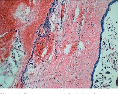 Figure 1 From Surgical Management Of Dentigerous Cyst And Keratocystic