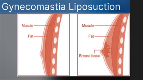 Gynecomastia Liposuction