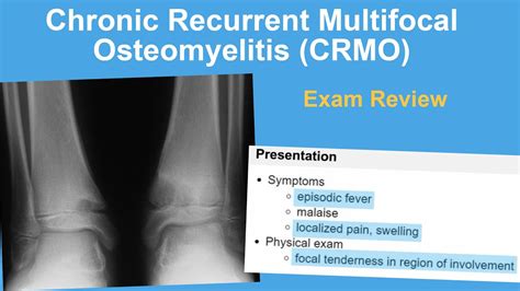 Chronic Recurrent Mulitfocal Osteomyelitis Crmo Exam Review Lindsay