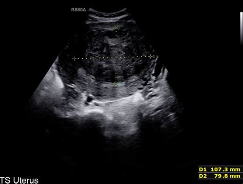 Fibroids Radiologywales