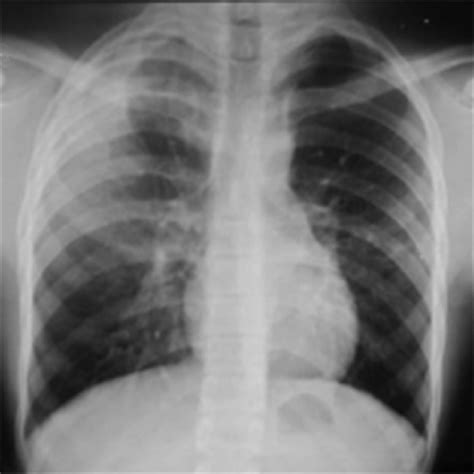 Case 2 Presenting Pa Chest Radiography Download Scientific Diagram