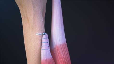 Biceps Tenodesis Procedure