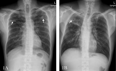 A Chest X Ray Of Case 4 Shows Nodular Opacity In Both Lungs B Chest