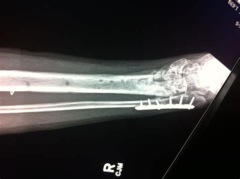 Tibial Plafond Fracture Anatomy