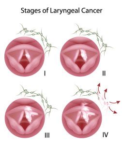 Staging Of Throat Cancer - Net Health Book