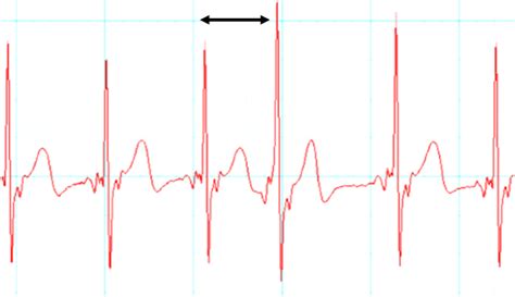 Rhythm Uctuation Electrocardiogram Showing Irregular R Waves The R R